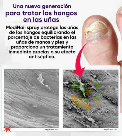 MEDINAIL™ -"ADIÓS A LOS HONGOS: ENCUENTRA EL ELIMINADOR IDEAL" Elimina los hongos en las uñas de forma rápida y efectiva